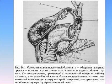 Желчные свищи
