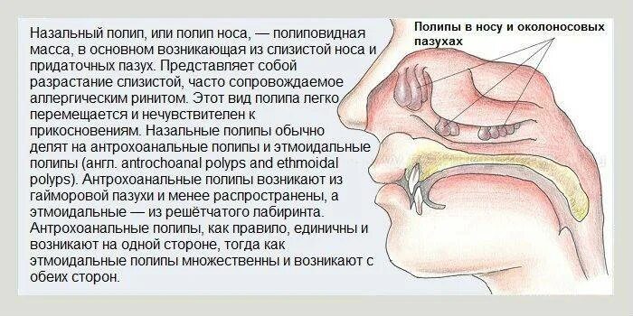 Полипы околоносовых пазух. Наиболее частая локализация полипов в носу. Полипы в полости носа и околоносовых пазухах. Заложен нос и пропало обоняние