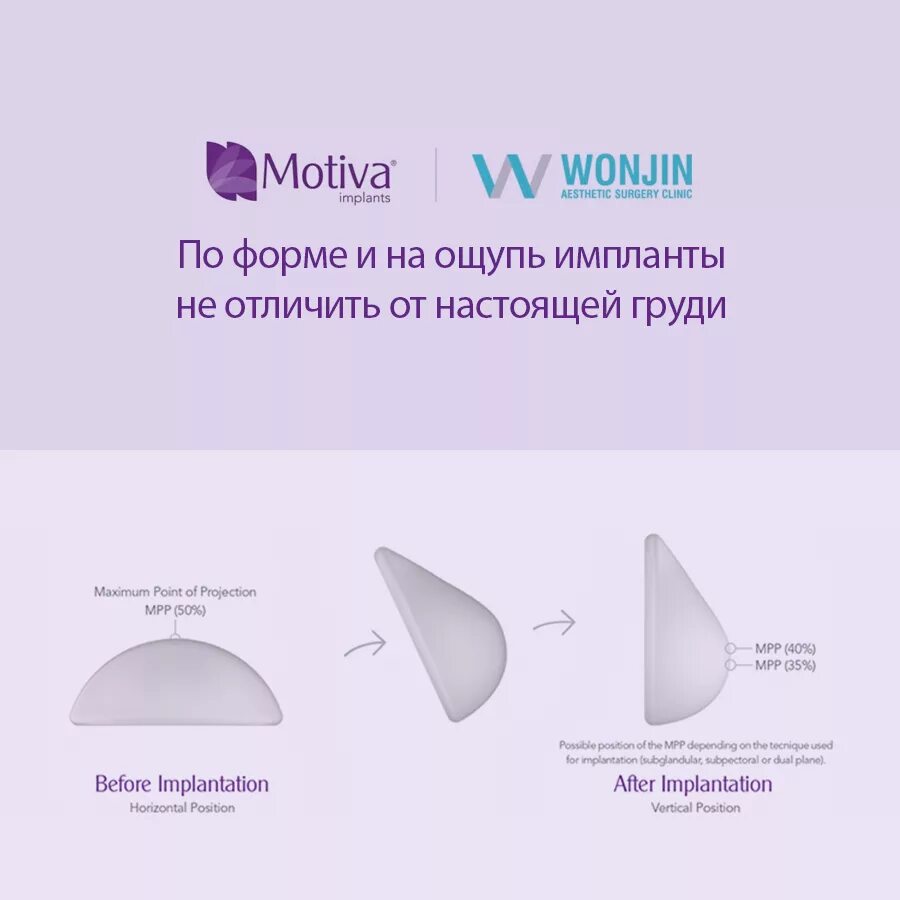 Какие размеры импланты. Импланты 380 грудные импланты. грудные импланты motiva. грудные импланты ментор анатомические. ментор анатомические импланты размерная.