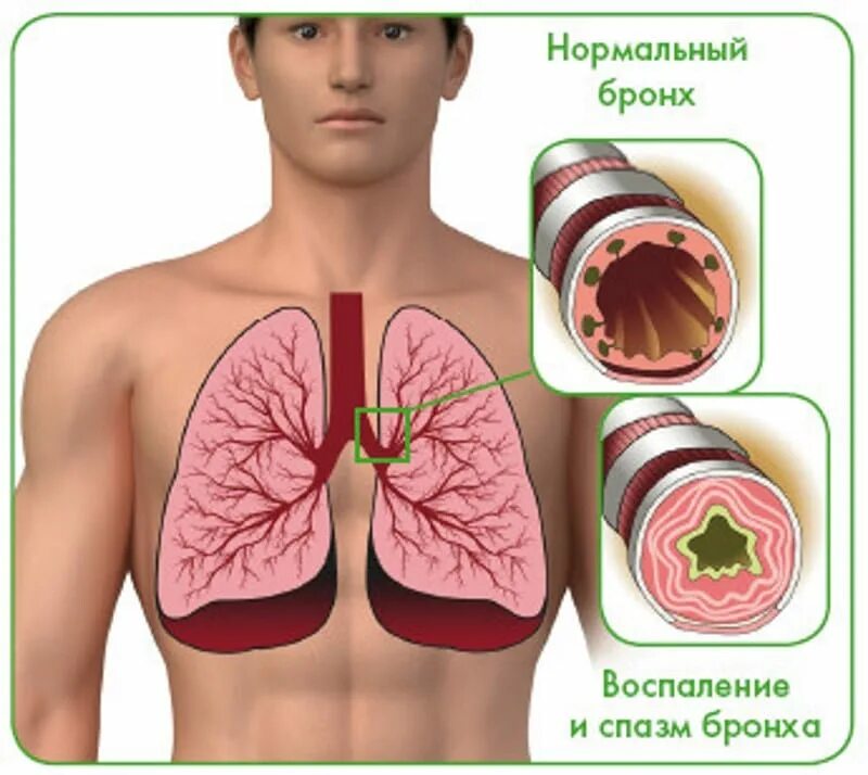 Здоровые бронхи и легкие.