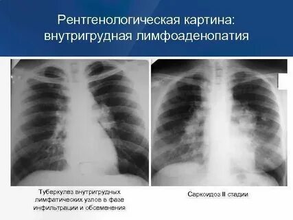 Внутригрудная лимфаденопатия
