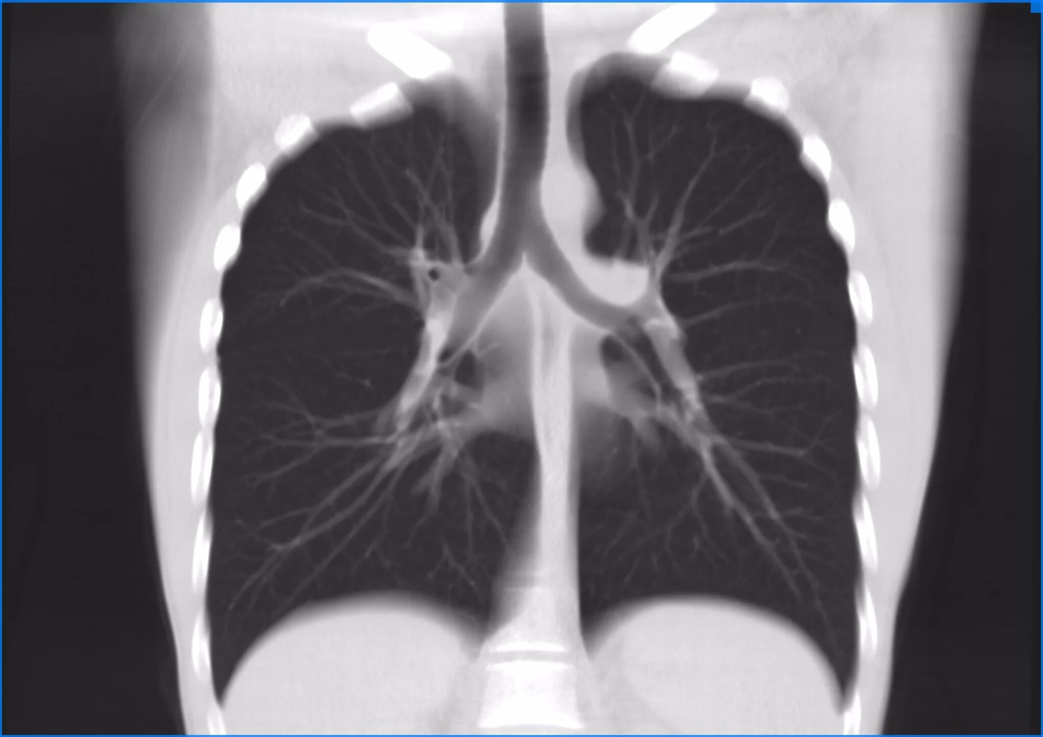 Кт чистых легких. Снимок кт легких. Кт огк с контрастированием. Лимфогенный канцероматоз легких. Канцероматоз плевры легких кт.