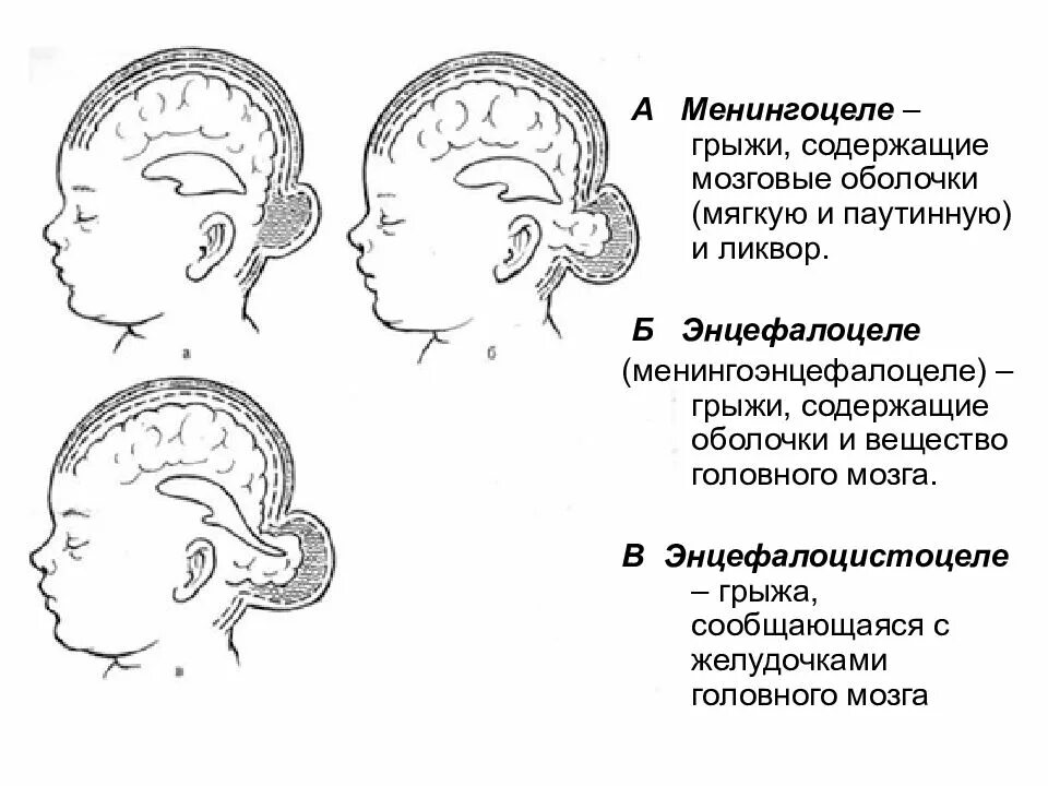 Поражение головного мозга у новорожденных. Затылочная грыжа черепно-мозговая. Черепно мозговая грыжа у плода. Врожденные черепно мозговые грыжи классификация. Менингоцеле черепно-мозговые грыжи.