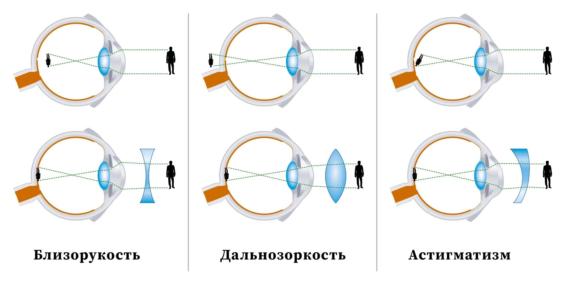 Зрение 3 какие линзы. Дефекты зрения близорукость и дальнозоркость. близорукость дальнозоркость астигматизм. коррекция зрения близорукость и дальнозоркость. линзы для глаз для зрения астигматизм.