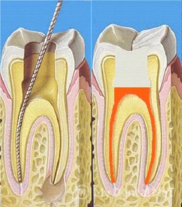 Пульпа пульпит периодонтит. 4 Канальный пульпит зуба. Пульпит 2 канального зуба. Пломбирование зуба после лечения каналов