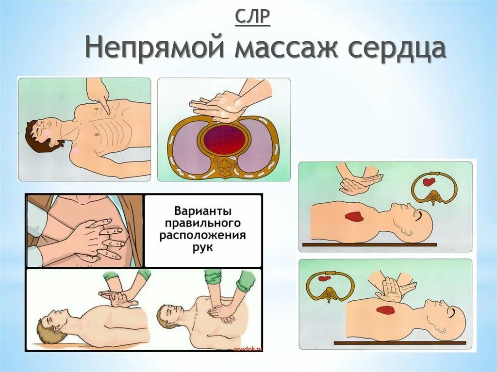 Не прямлй массаж сердца. Непрямой массаж сердца иллюстрация. Сердечно легочная реанимация непрямой массаж сердца. СЛР непрямой массаж сердца. Осложнения при закрытом массаже сердца