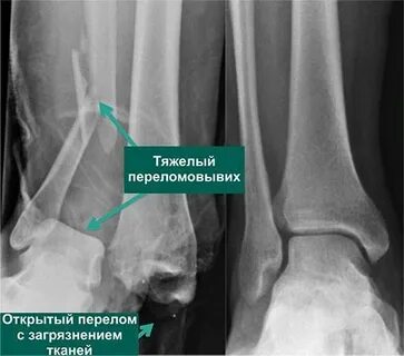 Застарелый перелом лечение