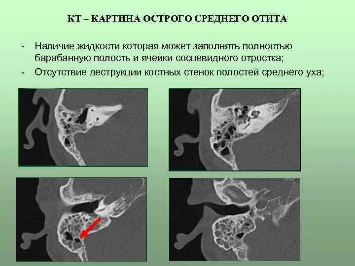 Утолщение слизистой сосцевидного отростка. Острый средний отит кт. Гнойный средний отит на кт. Хронический адгезивный средний отит кт.