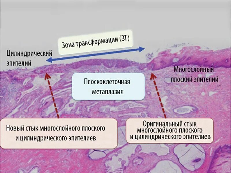 Изменения эпителия матки. Многослойный плоский эпителий шейки матки гистология. Ацетобелый эпителий дисплазия. Дисплазия шейки матки гистология. Дисплазия многослойного эпителия.