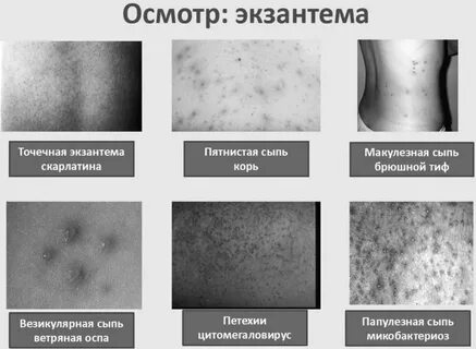 Сыпи при инфекции характер