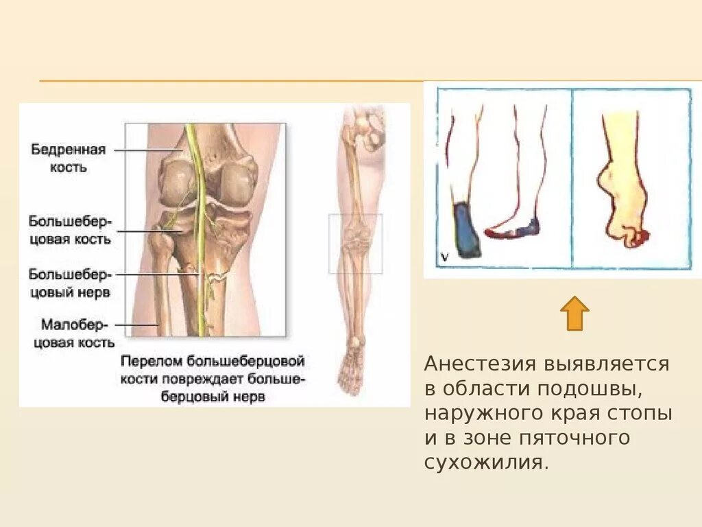 Нейропатия большеберцового нерва. Невропатия малоберцового нерва и большеберцового нерва. Повреждение общего малоберцового нерва. Невропатия (неврит) большеберцового нерва.