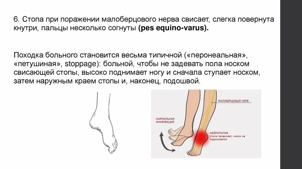 Невропатия стопы. Нейропатия малоберцового нерва. Нейропатия малоберцового нерва анатомия. Невропатия большеберцового и малоберцового нервов. Повреждение поверхностного малоберцового нерва.