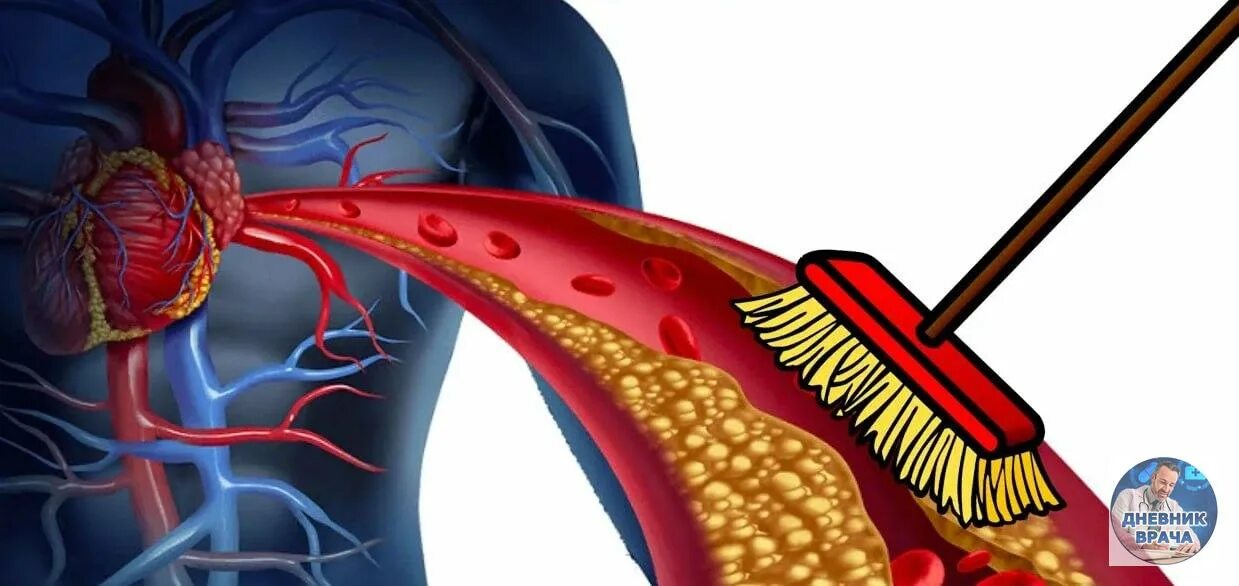 Чистка артерий и сосудов. Очищение сосудов. Чистка сосудов от тромбов. Как очистить сосуды от холестериновых тромбов