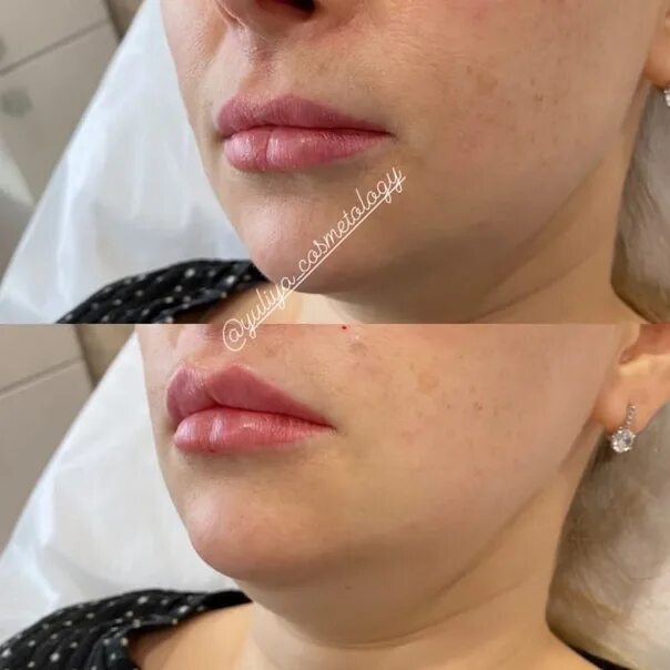 Губы 0 2 мл гиалуроновой кислотой. Белотеро липс шейп. Губы гиалуроновой кислотой бантиком. 6. Губы 0 6 мл гиалуроновой кислотой.