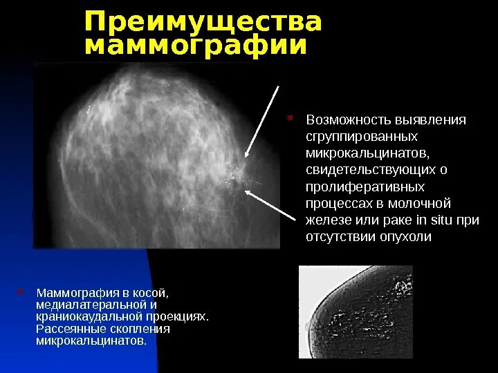 Маммография старый. Молочная железа маммография. Молочная железа в норме маммография. Норма молочной железы на маммографии. Маммография это исследование.