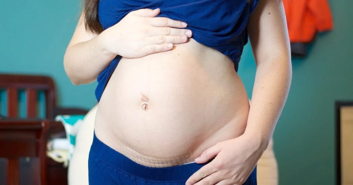 Живот женщины после беременности. Кесарево сечение живот. Кесарева беременность. Живот беременной.