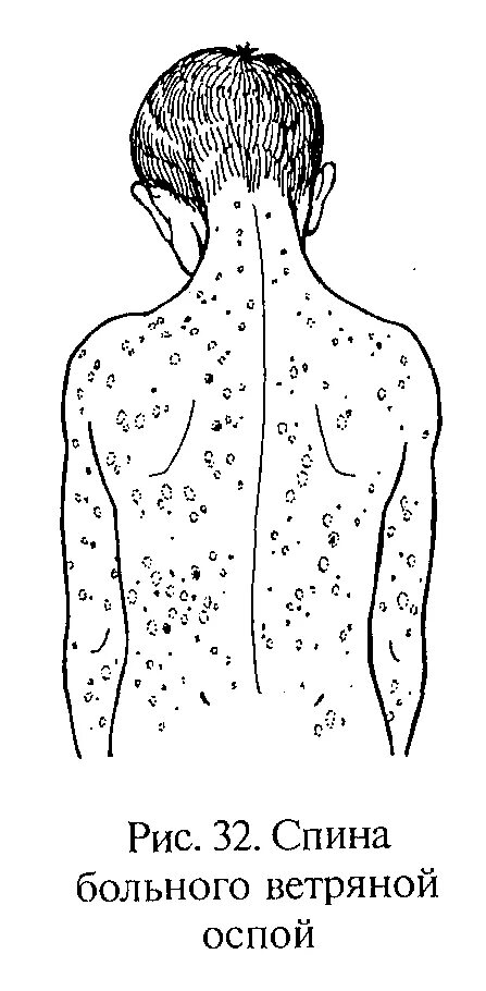 Локализация сыпи ветряной оспы. Схема локализации сыпи. Ветрянка этапность сыпи. Ветряная оспа схема высыпаний. Локализация кори