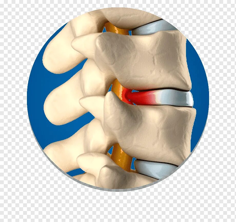 Спинные диски. Секвестрированная грыжа позвоночника. Грыжа межпозвонкового диска. Диски позвоночника. Межпозвонковый диск грыжа.