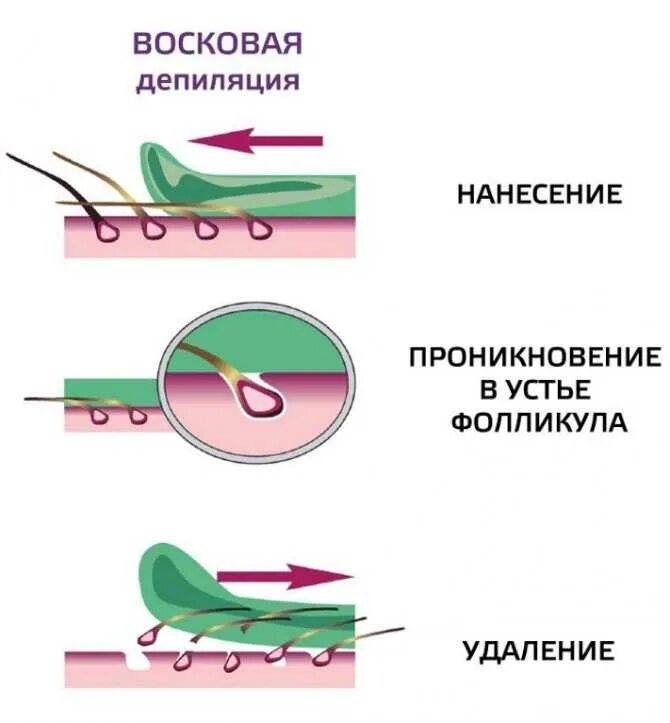 Как правильно удалить зону. Схема направления депиляции воском. восковая депиляция схемы роста волос. как наносить воск для депиляции по или против роста волос. как правильно наносить воск для депиляции.