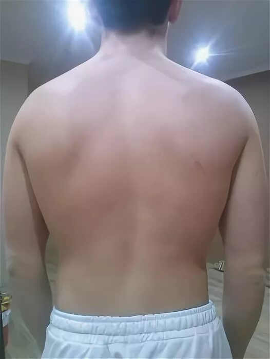 искривление позвоночника 17 градусов. искривление позвоночника 17. искривление позвоночника 17. рентген позвоночника сколиоз 2 ст. искривление позвоночника 17.