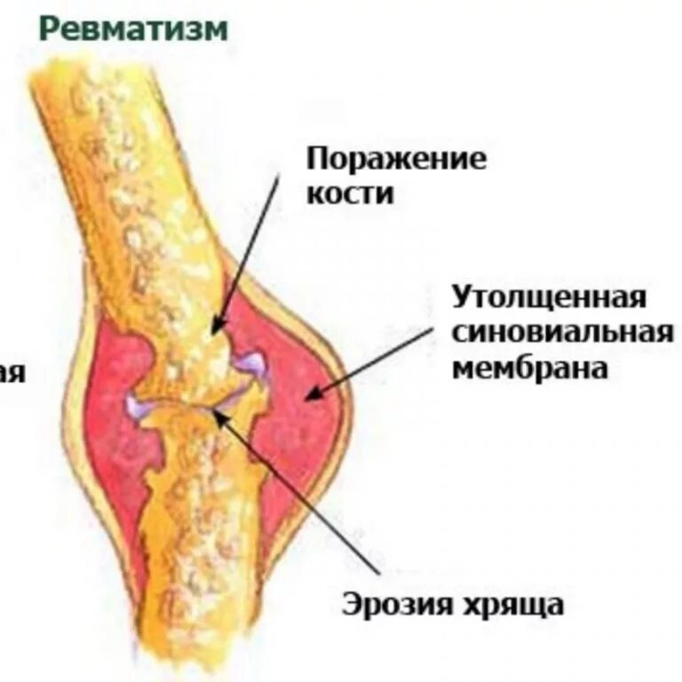 Как лечить ревматизм суставов. Как лечить ревматизм суставов