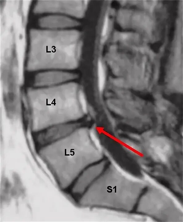 Протрузия дисков l2 l3 l4 l5. Диски позвонков l3-l4, l4-l5, l5-s1. Грыжи позвоночника l3-l4,l4-l5,l5-s1. Дорсальная грыжа диска l5-s1. Протрузии l4-s1.