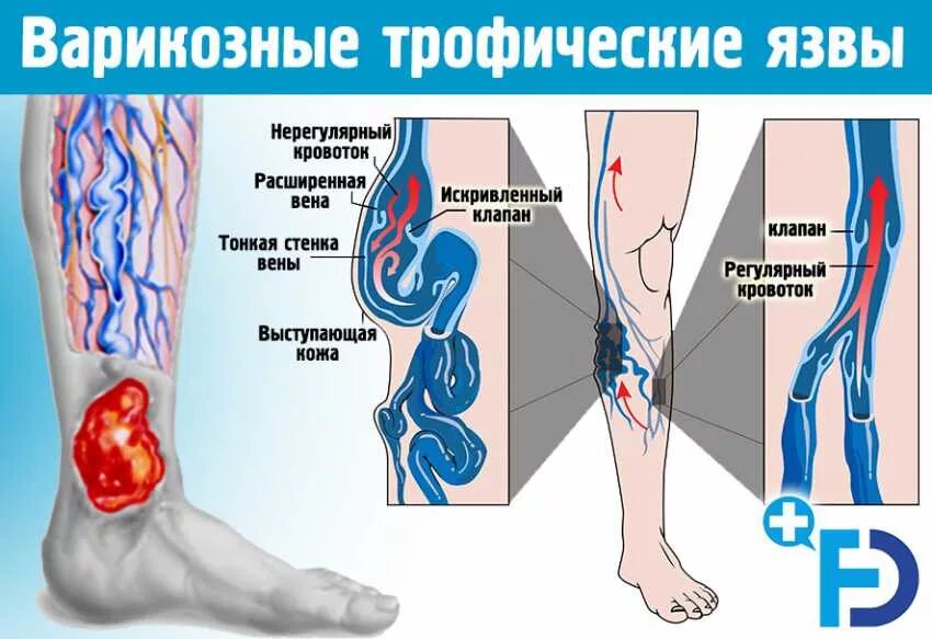 Расширение вен какой врач. Венозная недостаточность трофическая язва. Варикозно трофическая язва голени. Варикозное расширение вен нижних конечностей трофические язвы.