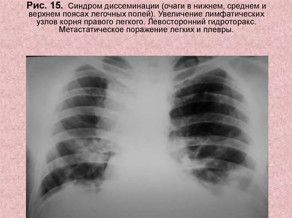 Тень в верхней доле. Синдром легочной диссеминации рентген. Очаги диссеминации в легких. Синдром диссеминации в легких. Синдром очагов в легочном поле.