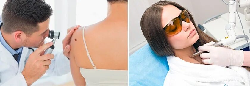 Удаление лазером la-15. Выведение татуажа лазером. Лазерное удаление татуировок. Удаление лазером гомель. Лазерное удаление тату.