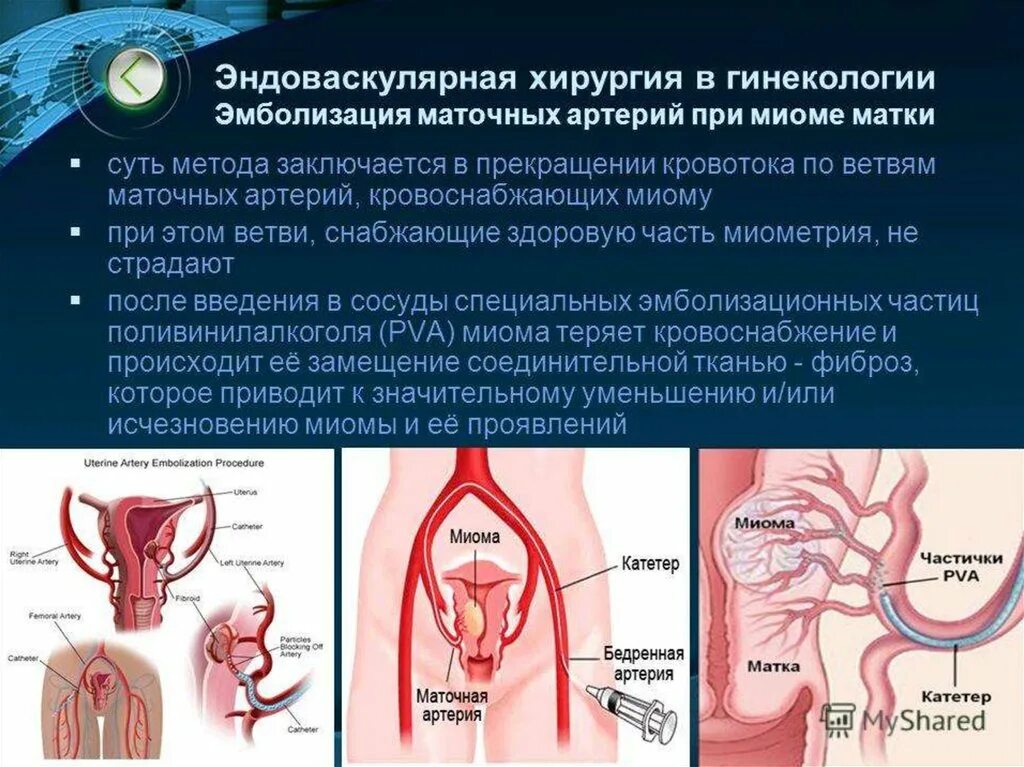 Эма миомы матки. Эндоваскулярная эмболизация маточных артерий. эмболизация маточных вен. эмболизация артерий методика. эмболизация сосудов матки.