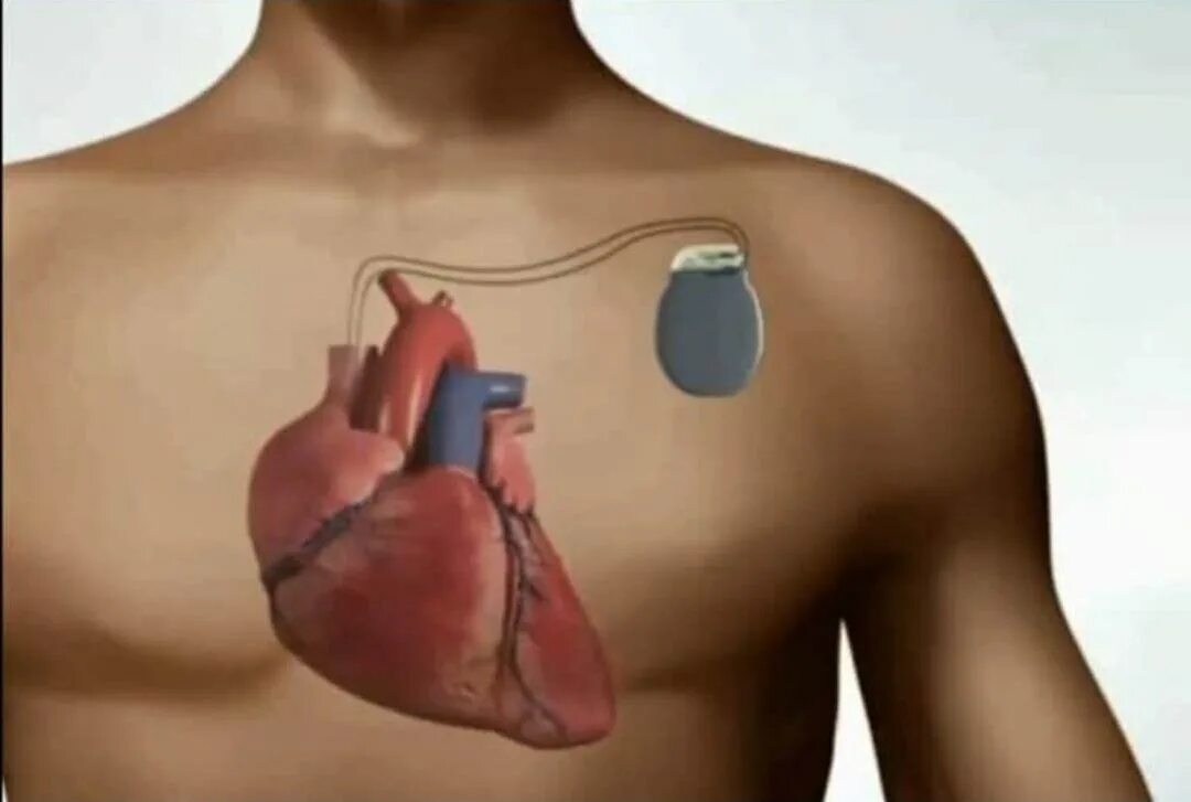 Если стоит кардиостимулятор можно. Имплантируемый кардиостимулятор 1956 года. Кардиостимулятор операция. Кардиостимулятор сердца. Подкожный кардиовертер дефибриллятор.