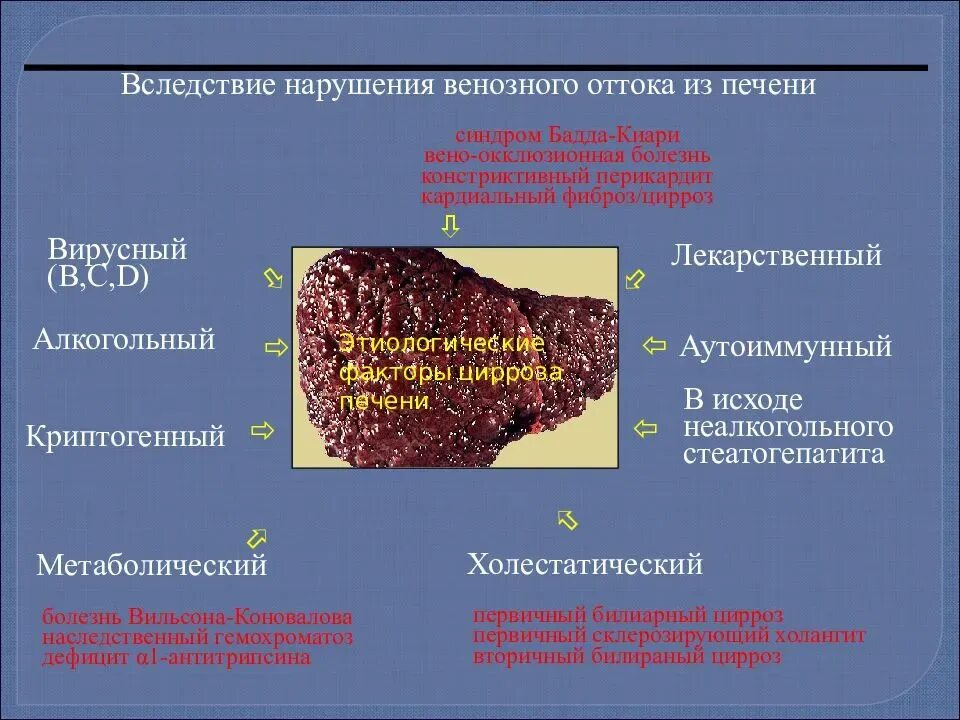 Макронодулярный цирроз печени. Субкомпенсированный цирроз печени. Криптогенный цирроз печени. Цирроз печени патоморфоз.