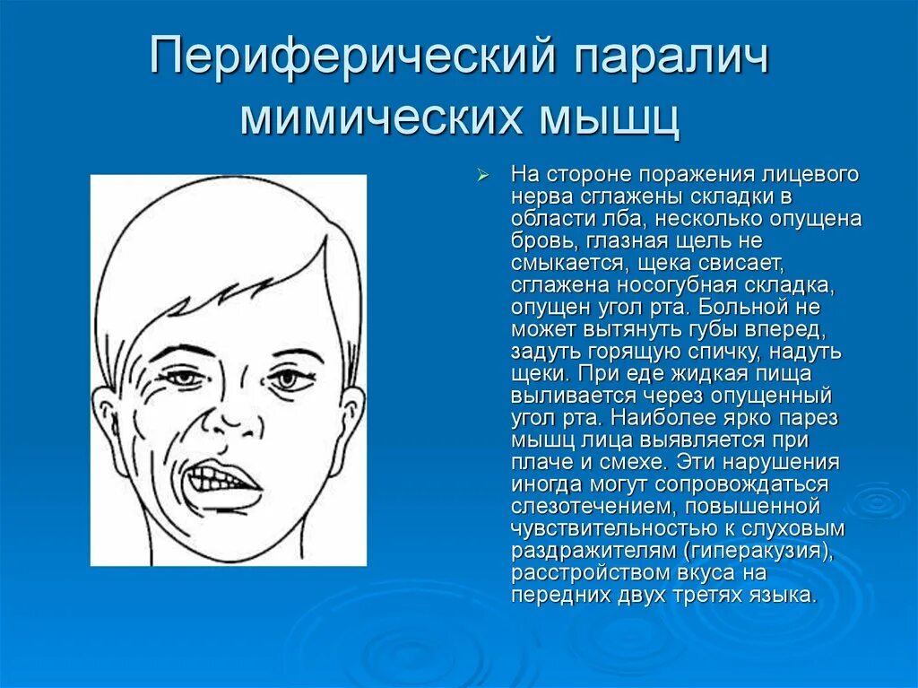 Порез лицевого. Парез мимической мускулатуры симптомы. Периферический паралич мимической мускулатуры. Периферический парез мимических мышц. Периферический паралич мимических мышц возникает при поражении.