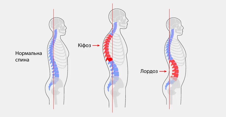 Кифоз грудного отдела степени. Кифоз лордоз грудного отдела позвоночника. искривление позвоночника гиперлордоз. кифоз шейного отдела позвоночника. кифоз вид сзади.
