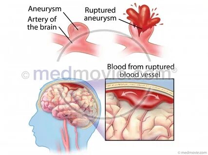 Aneurysm перевод