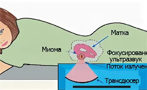Абляция миомы. Фуз-абляция миомы матки. ультразвуковая абляция миомы. абляция фокусированным ультразвуком под контролем мрт.