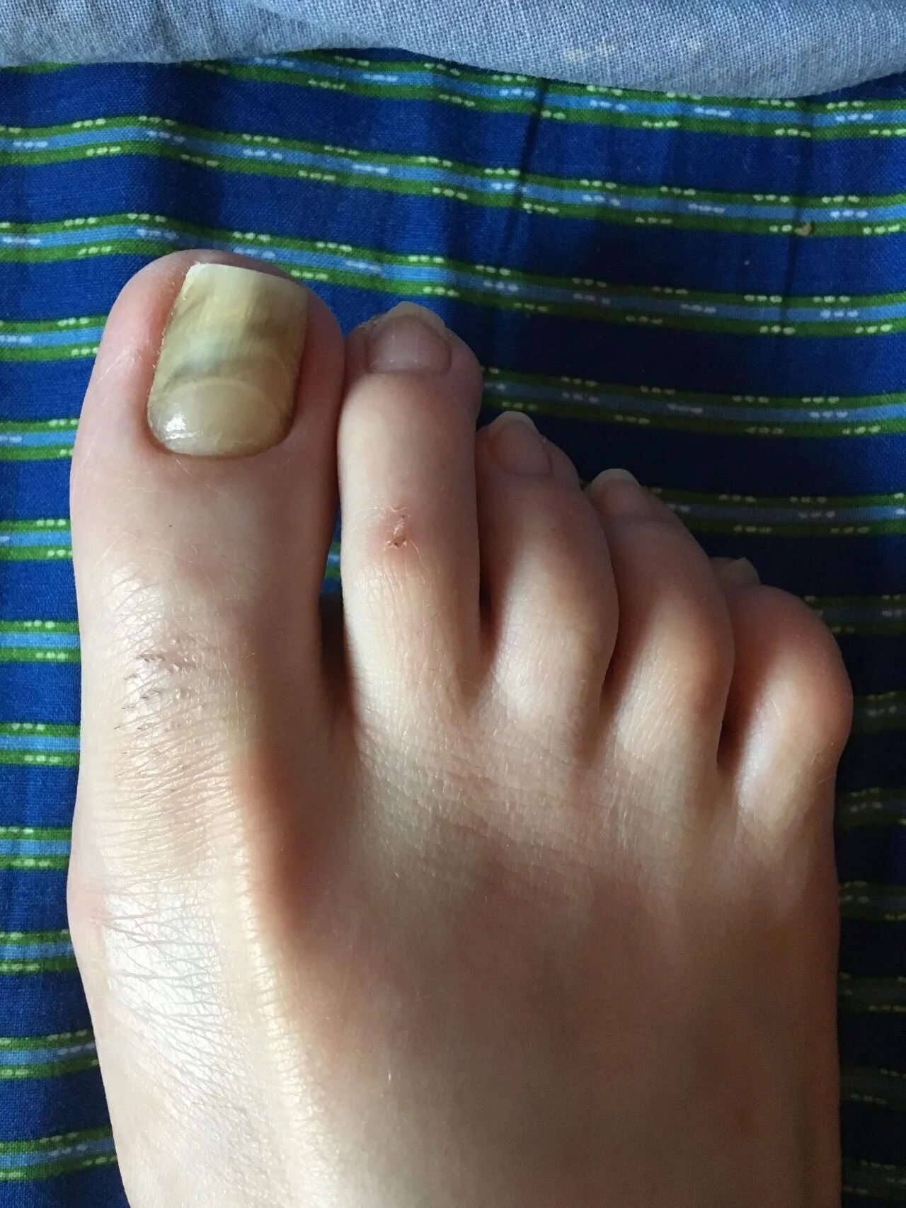 От чего синеют ногти. Ноготь на большом пальце ноги. вкрученные ногти на ногах. отслаиваются ногти на ногах большие пальцы.