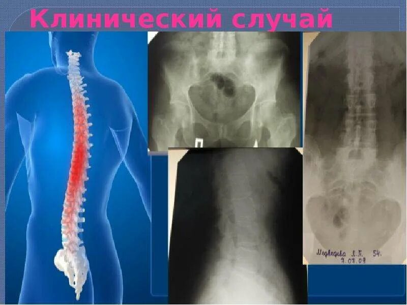 Болезнь бехтерева анкилозирующий. Анкилозирующий спондилоартрит болезнь бехтерева. анкилозирующий спондилит идиопатический. анкилозирующий артрит. анкилозирующий спондилез.