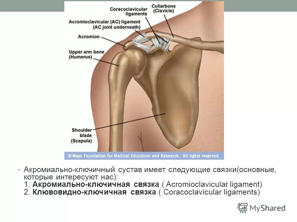 Лечение ключично акромиального артроза. Артроз 2 ст. правого акромиально-ключичного сочленения.. Акромиально-ключичное сочленение плечевого сустава. Стадии остеоартроза плечевого сустава. Сесамовидные кости акромиально ключичного сустава.