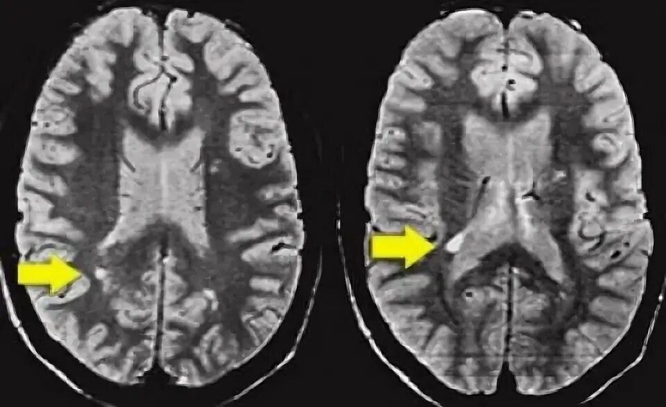 Шкала фазекас мрт. Лейкоареоз и гидроцефалия. Очаги глиоза на мрт. Перивентрикулярный лейкоареоз головного мозга на кт. Перивентрикулярный глиоз на мрт.