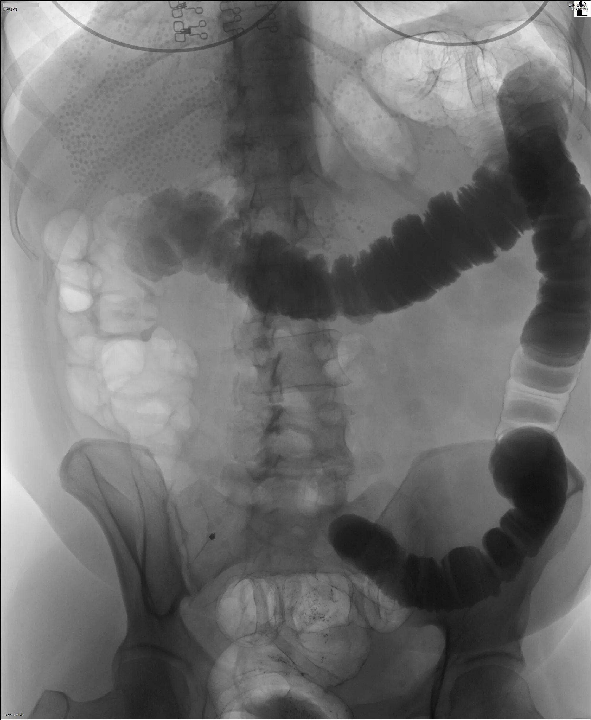 Атония кишечника рентген. Петли Толстого кишечника рентген. Раздутые петли Толстого кишечника рентген. Трансверзоптоз кишечника рентген. Расширение петель кишечника