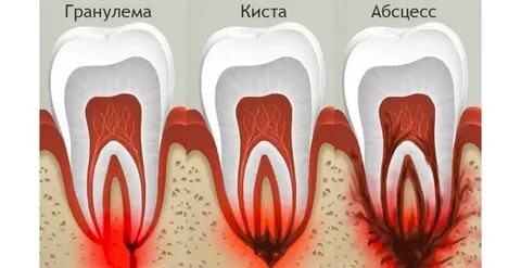 Температура после абсцесса
