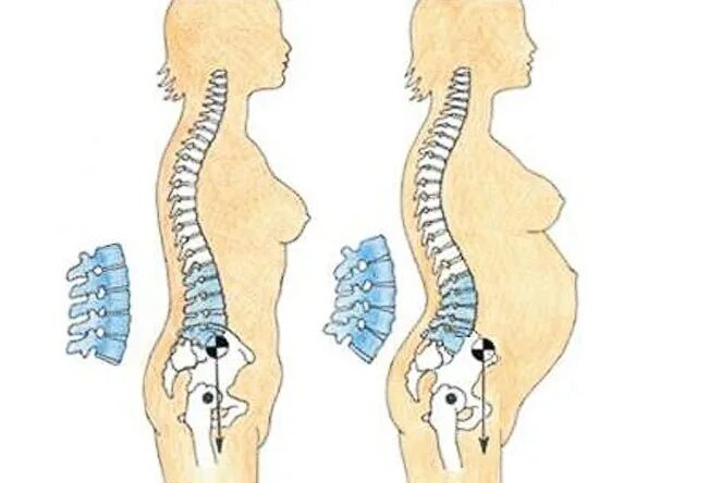 Спина после беременности. Поясничный лордоз при беременности. Позвоночник беременной женщины. Позвоночник после родов. Перегиб позвоночника в поясничном отделе.