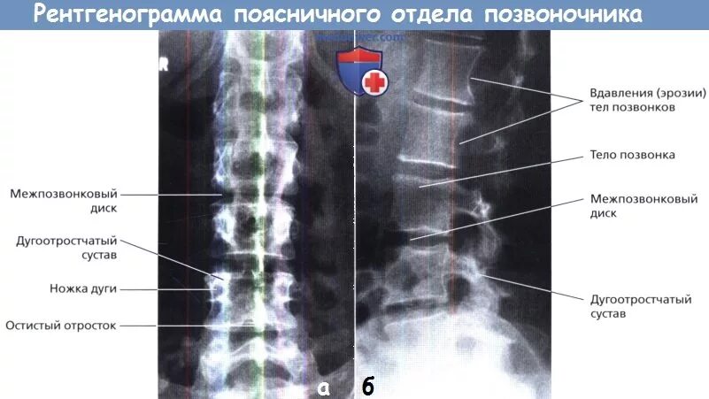 Рентгенография поясничного отдела позвоночника подготовка. Рентгенограмма поясничного отдела. Рентгенография позвоночника. Рентген поясничного отдела позвоночника. Рентген поясничного отдела позвоночника в двух проекциях.