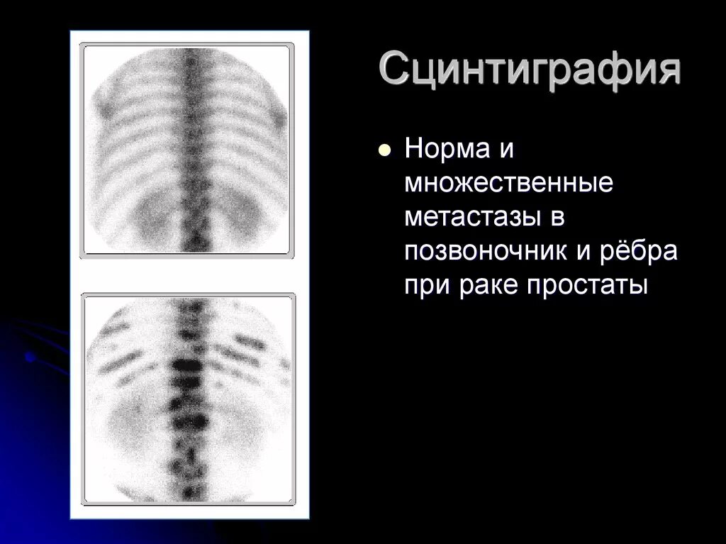 Метастазы в кости при раке предстательной