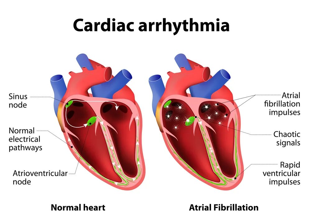 Проводящая система сердца. Проводящая система сердца схема. Аритмия. Аритмия сердца. Предсердие болезни
