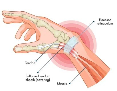 De Quervain’s tendinitis is caused when tendons on the thumb side of the wr...