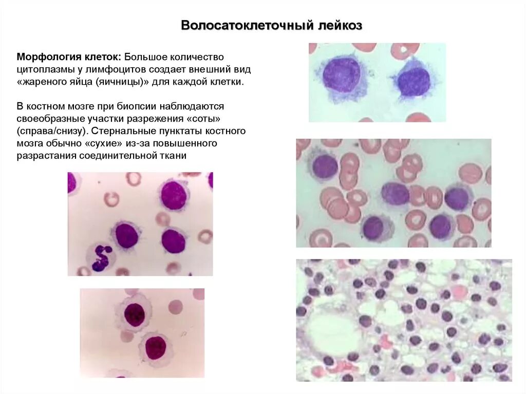 Волосатоклеточный лейкоз костный мозг. Волосатоклеточный лейкоз кровь. Волосатоклеточный лейкоз гистология. Морфология лейкозных клеток. Реактивные лимфоциты у детей