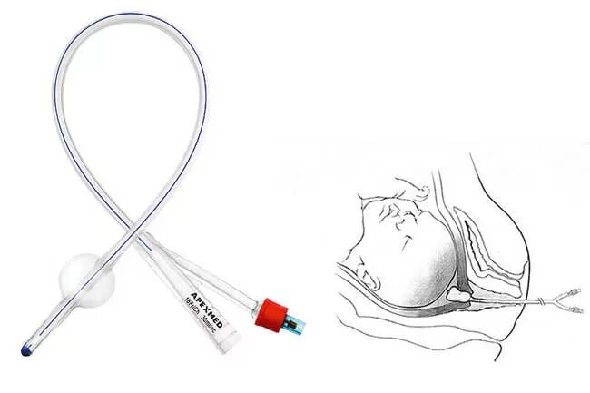 Цервикальный катетер фолея. Стимуляция катетером. Катетер фолея 18 fr 8 мм 30 мл. Катетер померанцева-фолея (фолея). Катетер фолея для стимуляции родов.
