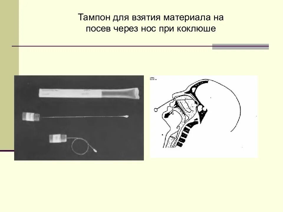 Взятие мазка из носа алгоритм. Взятие мазка на коклюш алгоритм. взятие материала на коклюш. коклюш методом кашлевых пластинок.